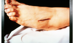 SERRANO Andres (US), The Morgue : Rat poison suicide II, 1992, Cubachrome, Photographie 3/3, 152,5 x 165 cm, Collection de la province de Hainaut - Dépôt au BPS22, Charleroi (B) © Andres Serrano